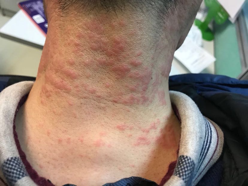 1、膏藥過敏怎么辦？