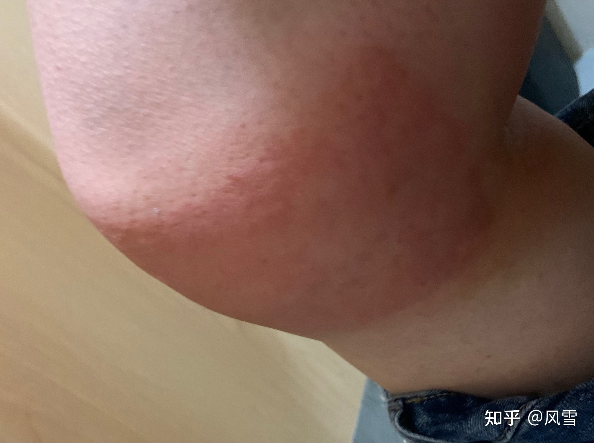 1、貼膏藥過敏癢紅腫怎么辦？