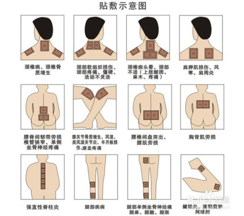 1、肩痛買什么膏藥可以貼？