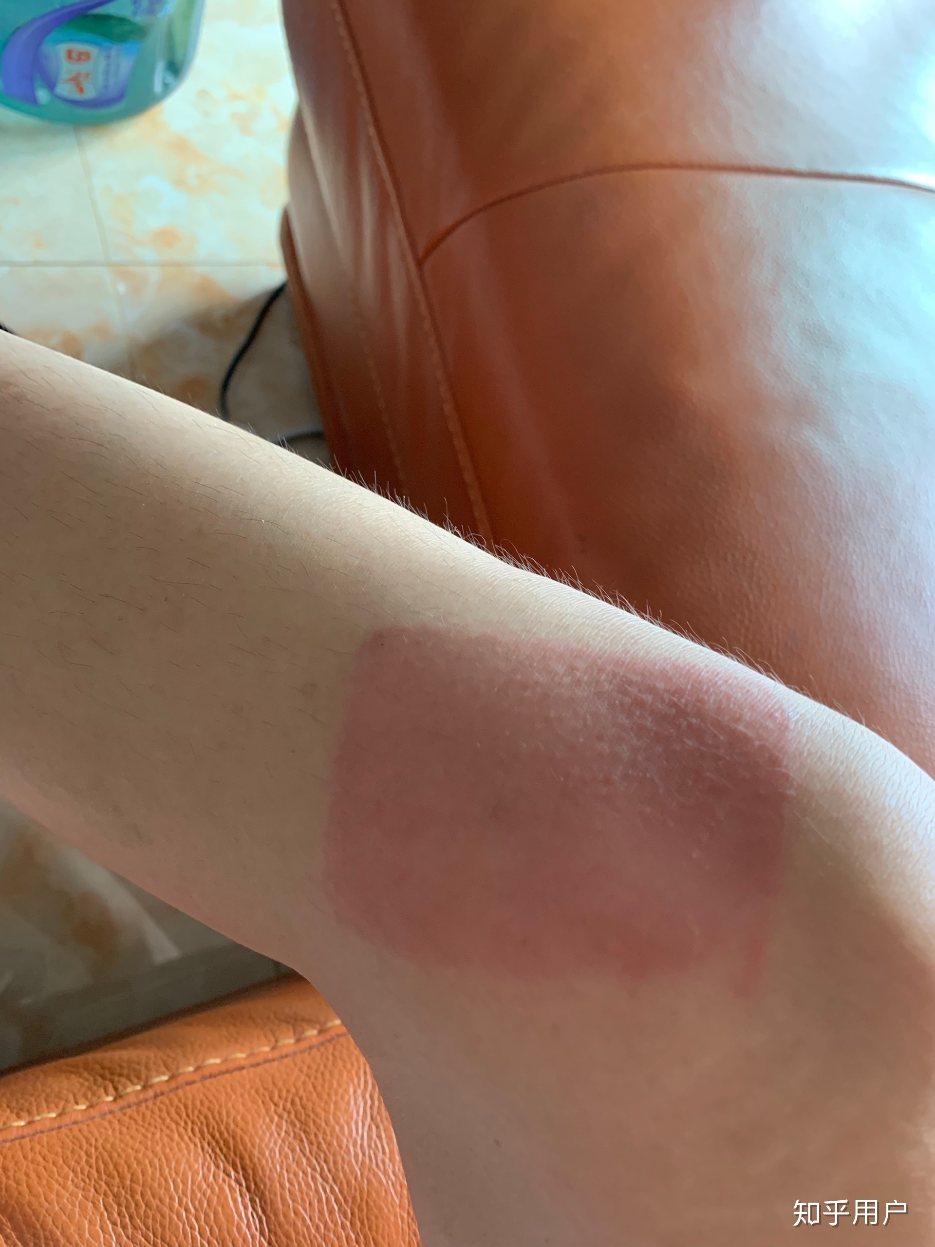 2、貼膏藥的地方有很多紅疙瘩，好不好？